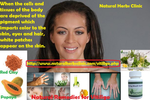 Fortunately for me, I’ve never been one to put too much faith in western medicine. I started dabbling in alternative medicine, searching natural remedies for vitiligo treatment, and that’s where I stumbled onto Michael Dawson’s Natural Vitiligo Treatment System.... http://bit.ly/2hb76QJ