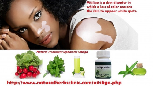By using the aloe vera for Natural Treatment of Vitiligo remove orally say if you apply on white skin patches regularly will cure the vitiligo and same like vitiligo spots very easily, but you have to stop using chemical soaps cosmetics etc for getting fine results of aloe vera... http://www.naturalherbsclinic.com/aloe-vera-for-vitiligo