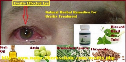 Whether the steroid is administered as an eye drop, pill or injection depends on the type of uveitis you have. Because iritis affects the front of the eye, Treatment for Uveitis usually treats with eye drops.... http://www.naturalherbsclinic.com/uveitis/uveitis-causes