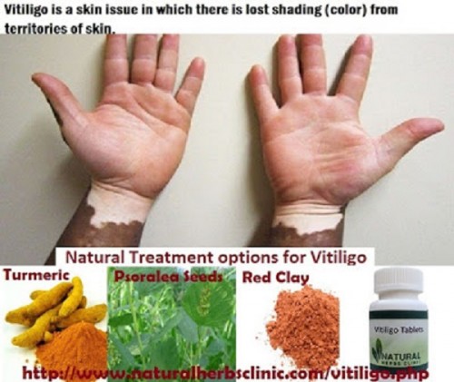 The Vitiligo Symptoms are the Level zones of ordinary feeling skin with no color show up all of a sudden or slowly. These zones have a darker outskirt… http://vitiligosymptom.blogspot.com/2016/11/about-vitiligo-symptoms-causes-and.html