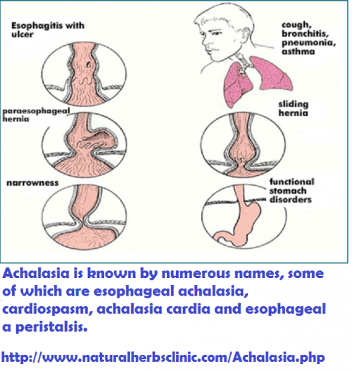 The easy technique to handles sore throats is to pop anti-inflammatory tablets with water. Yet, Achalasia Natural Treatment can a few times support the much or expressively more and they’re normally accessible... http://www.naturalherbsclinic.com/Achalasia.php