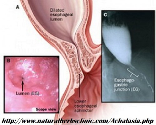 The traditional method to the Treatment of achalasia is based on stretching or cutting the muscle fibers at the esophagogastric joint by pneumatic dilatation or surgical myotomy... http://www.naturalherbsclinic.com/blog/esophagus-achalasia-the-muscular-tube-of-swallowing/