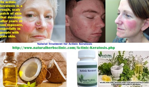 Some homes remedies you can try to help get rid of the cosmetic part of the skin condition: the rough, scaly, discolored patches of skin. Natural Treatment for Actinic Keratosis you can try to get rid of skin cancer.... http://actinickeratosisdisease.blogspot.com/2017/03/actinic-keratosis-natural-treatment.html