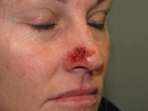 The Actinic Keratosis Symptoms are little and observable red, brown, or skin-colored patches that don't go away. They ordinarily happen on the head, neck, or hands yet can be found on different regions of the body.... http://herbalresource.livejournal.com/944.html