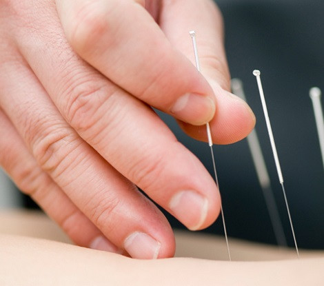 AcupunctureForPain-1.jpg