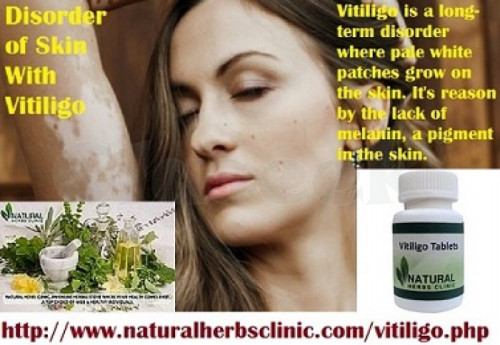 Vitiligo is a repulsive skin issue in which the skin cells that make melanin and color are crushed. Melanin is the key substance that gives us characteristic shading skin... https://naturalherbsclinic.voog.com/early-stage-of-vitiligo