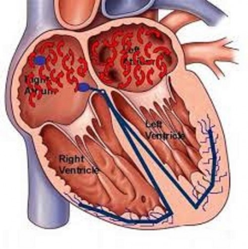 Palpitation, tiredness, shortness of breath, dizziness or feeling faint is some of the clear Atrial Fibrillation Symptoms. In any case, a few people just have mild symptoms, while other individuals have no indications by any means.... https://naturalcureproducts.wordpress.com/2016/10/21/natural-treatment-for-atrial-fibrillation/