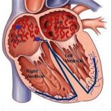 AtrialFibrillationSymptoms