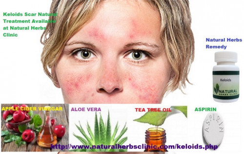 Indeed, through this Natural Treatment for Keloids can immediately be cured, flat or missing. But, at least this treatment will make the skin free of problems and prevents the appearance of keloids during the healing time progresses.... http://www.naturalherbsclinic.com/blog/keloid-treatment-tea-tree-oil/