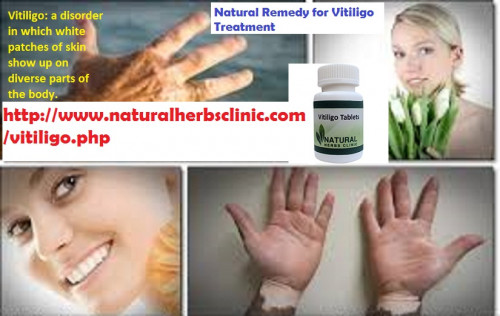 Lesions on the face, trunk responds to a greater extent than lesions on extremities with lesions on hands and feet having the least favorable Vitiligo Prognosis.... http://www.naturalherbsclinic.com/Vitiligo/vitiligo-prognosis