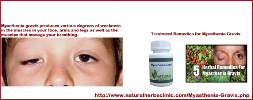 If one eyelid is extremely droopy and blocks the vision in that eye, the double vision will not require a separate Myasthenia Gravis Alternative Treatment. Usually special glasses with prisms are not helpful because of the considerable fluctuation in the amount of double vision in patients with myasthenia gravis.... http://www.naturalherbsclinic.com/ocular-myasthenia-gravis-treatment
