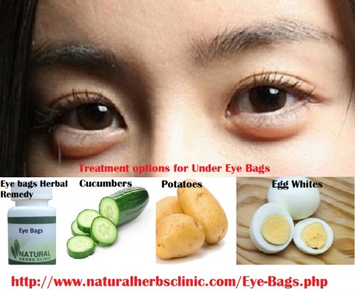 The Best Treatment for Eye Bags is accessible at your home itself without using and non-organic products. Just make assured that you regularly follow the medications to develop the preferred outcomes within a shorter period span.... http://whatareeyebags.inube.com/blog/4413947/eye-bags-and-its-recovery-method/