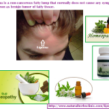 C-Lipoma-Treatment-in-Homeopathy-Lipoma-Alternative-Treatment---Natural-Herbs-Clinic