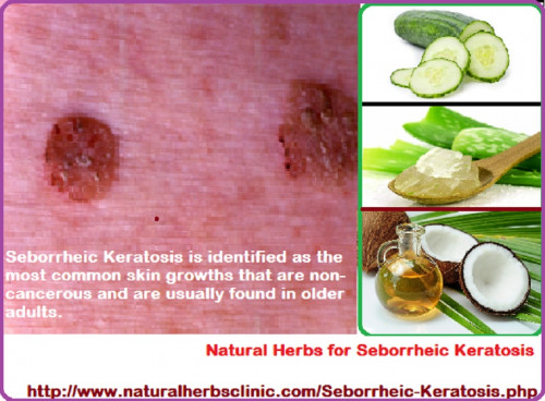 C Natural Herbs for Seborrheic Keratosis Natural Herbs Clinic