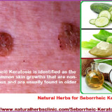 C-Natural-Herbs-for-Seborrheic-Keratosis---Natural-Herbs-Clinic
