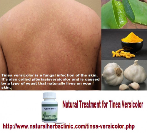 It does not get any more natural than using Natural Herbs for Tinea Versicolor. Throughout this site you can find many over-the-counter treatments for Tinea Versicolor that are 100% natural and very beneficial to your health... http://www.naturalherbsclinic.com/tinea-versicolor/natural-herbs-for-tinea-versicolor