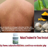 CNaturalHerbsforTineaVersicolor-NaturalHerbsClinic