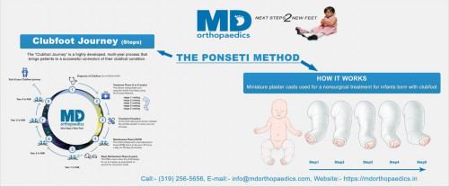 Clubfoot-Treatment-Ponseti.jpg