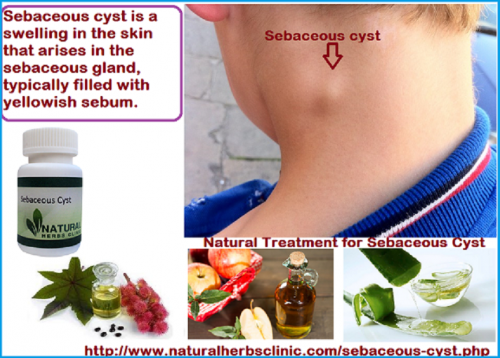 Tried and tested easy Natural Treatment for Sebaceous Cyst which can be a big help in the process of sebaceous cyst removal.... http://www.naturalherbsclinic.com/sebaceous-cyst/sebaceous-cyst-home-treatment