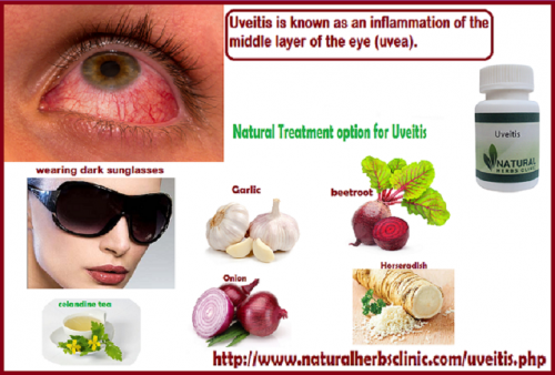 There is no known Natural Treatment for Uveitis. While waiting for the recommend medications to take effect, wearing dark sunglasses can help with the light sensitivity.... http://www.naturalherbsclinic.com/uveitis/uveitis-treatment-drugs