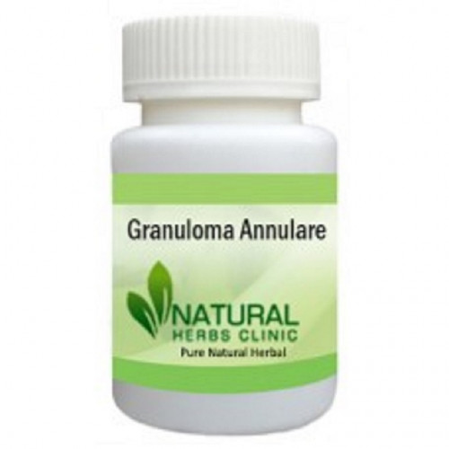 Green tea has been connected to healing properties it is Herbal Treatment for Granuloma Annulare if consumed regularly. Try drinking green tea, at least, two times a day... https://granulomaannularecauses.blogspot.com/2019/08/granuloma-annulare.html