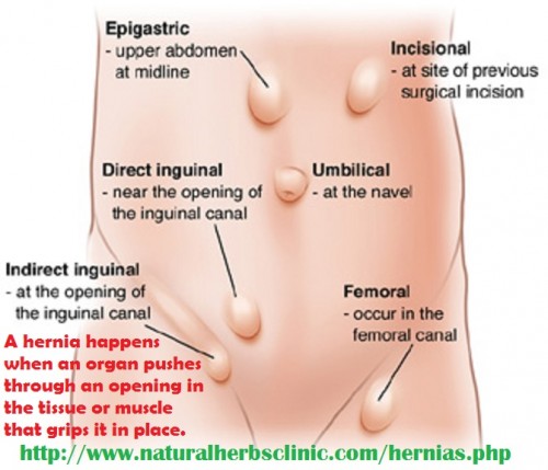 The most conjoint Hernia Symptoms is a lump or bulge in the affected part. In the case of an inguinal hernia, you might view a lump on either side of your pubic bone where your thigh and groin meet. You’re more probable to feel hernia through touch when you’re standing up.... http://herniasymptom.blogspot.com/2017/02/symptoms-and-treatment-of-hernia.html