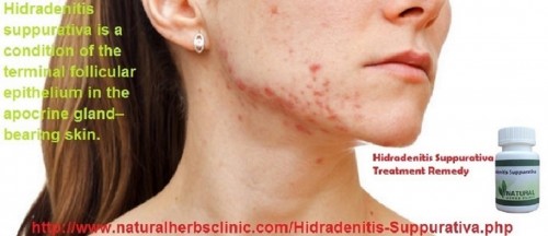 The Hidradenitis Suppurativa treatment "is hardly seen in the literature for this disease," reported Aude Nassif, MD, here at the American Academy of Dermatology 70th Annual Meeting.... http://hidradenitissuppurativadisease.blogspot.com/2016/10/study-suggests-new-treatment-for.html