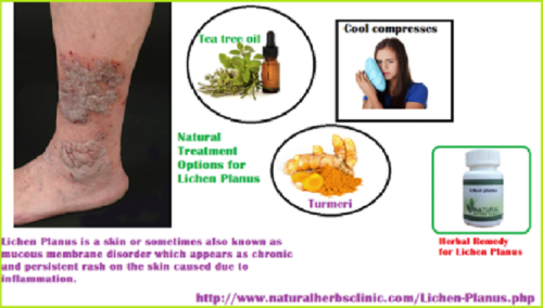 Aloe Vera can do wonders for health and so is Natural Treatment for Lichen Planus. Local application of Aloe Vera extract can soothe your skin and help get you rid of those ugly looking pigmented patches.... https://naturalcureproducts.wordpress.com/2017/11/06/home-remedies-for-lichen-planus/