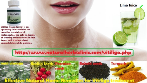 There are oral recommendation treatments, topical treatments and light therapy. But because not everybody has access to these treatments, some patients just rely on Vitiligo Natural Treatment to control their skin condition. Let me share to you some of the popular natural home remedies for vitiligo.... https://www.lybach.com/blog/2952/homemade-natural-treatment-for-vitiligo/