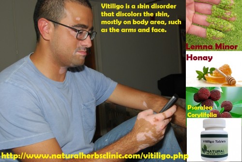 Honey is simple to search and is a rapid remedy for Vitiligo Natural Treatment. Organic honey might be bought in supermarkets and shops or local farms. Honey can be used in two techniques, but equally should be carried out simultaneously... http://herbelsolution.jimdo.com/2016/10/27/how-you-can-naturally-recover-vitiligo-using-3-methods/