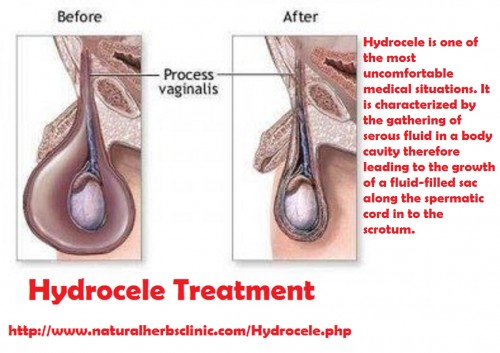 Hydroceles are generally non-dangerous and need no treatment unless they are big sufficient to cause discomfiture or distress. Hydrocele Treatment also becomes essential when they get large sufficient to obstruct blood provide to the testicles... http://hydroceletreatment.edublogs.org/2017/01/28/hydrocele-define-with-symptoms-and-treatment/