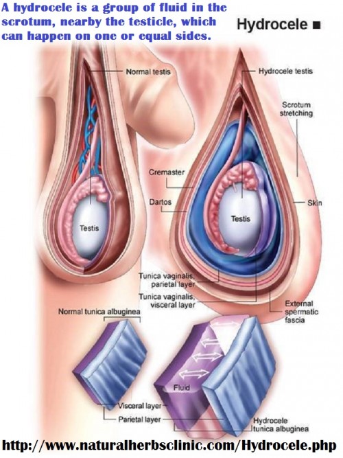 Frequently a hydrocele does not reason symptoms. You may notification development of your scrotum. Hydrocele Symptoms, when happen, can contain pain, inflammation, or redness of the scrotum or a sensation of density at the base of the penis.... http://herbclinic.inube.com/blog/5636475/symptoms-and-herbal-treatment-of-hydrocele/