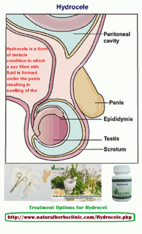 The main hydrocele symptoms are swelling in the scrotum. Usually, hydroceles do not reason pain; however, mature males may feel uneasiness.... http://hydrocele-treatment.webnode.com/hydrocele-symptoms-and-causes-treatment-for-hydrocele/