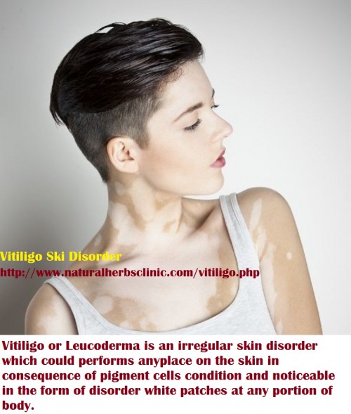 The initially Vitiligo Symptoms and signs may extent progressively or dynamically. The exact causes for vitiligo condition have been not recognized. It may be brought on by a misunderstanding influencing the melanocytes in the skin... http://vitiligonaturaltreatments.edublogs.org/2017/02/22/information-about-vitiligo-symptoms-and-its-treatment-technique/