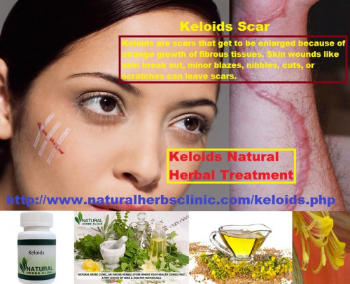 Keloids scars won't go way even if you rub and/or discover the best ever keloids scar cream that's out in the market today.... http://bit.ly/2xRgLHi