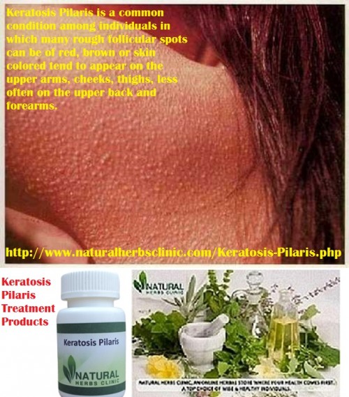 If you’r effected with keratosis pilaris skin disease then you be very careful when shopping for the finest Keratosis Pilaris Treatment Products for your face. The face is a much sensitive part and applying the wrong formula on your face might do more damage than good.... http://www.naturalherbsclinic.com/blog/keratosis-pilaris-a-skin-condition/