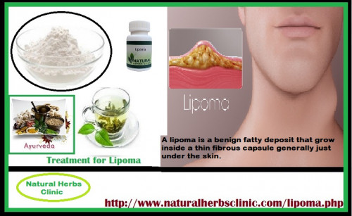 Though, there are a few home remedies and Lipoma Herbal Treatment that you might want to try first before going this route... http://herbsclinic.edublogs.org/2017/11/09/natural-herbal-treatment-for-lipoma-fatty-lumps/