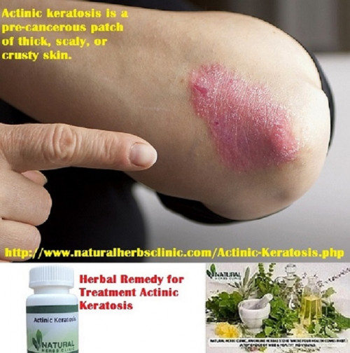 Fortunately, you can use actinic keratosis natural treatment to manage the lesions before they advance..... http://actinickeratosisdisease.blogspot.com/2017/09/actinic-keratosis-natural-treatment.html