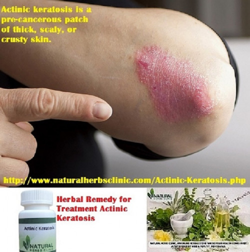 MildActinicKeratosisTreatmentActinicKeratosis-NaturalHerbsClinic.jpg