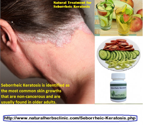There are a number of home remedies and Seborrheic Keratosis Treatment Natural available. This is a welcome report considering the expensive procedures that medical practitioners usually employ... https://herbclinic.jimdo.com/seborrheic-keratosis-scalp-removal/
