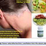 Natural-Treatment-for-Seborrheic-Keratosis---Natural-Herbs-Clinic