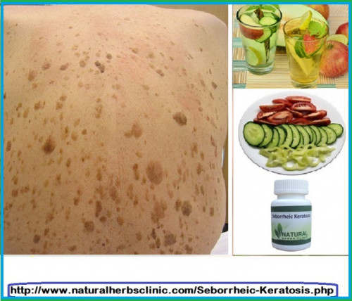This is particularly if these treatments are executed completely. Seborrheic Keratosis is known to recur and show proliferation. Therefore effective Seborrheic Keratosis Natural Treatment could mean lesser trips to the doctor's.... https://herbalresource.livejournal.com/2240.html