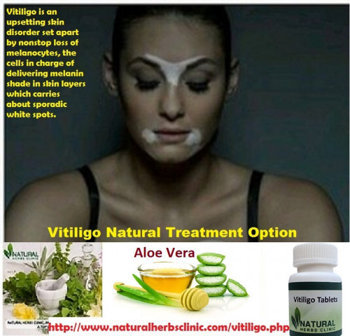Some patients just rely on Natural Treatment of Vitiligo to manage their skin condition. Let me share to you some of the popular natural home remedies for vitiligo with Aloe Vera gel.... http://www.naturalherbsclinic.com/blog/natural-treatment-of-vitiligo-with-aloe-vera/