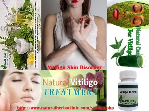 I might want to acquaint with you the top Vitiligo Natural Treatment infection that makes the white fixes in your skin less obvious. Keep perusing to know more. Turmeric, Apple Cider Vinegar, Honey, Ginger are very effective ingredients for the treatment of vitiligo naturally... http://www.naturalherbsclinic.com/blog/symptoms-and-natural-treatment-method-for-vitiligo/