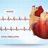 NewTreatmentofHeartDisorderAtrialFibrillation