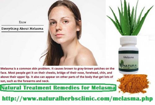 As with any kind of Natural Treatment for Melasma, it takes time. But the result is permanent and free from any side effects... http://www.naturalherbsclinic.com/blog/protect-your-skin-and-upper-lip-from-the-melasma/