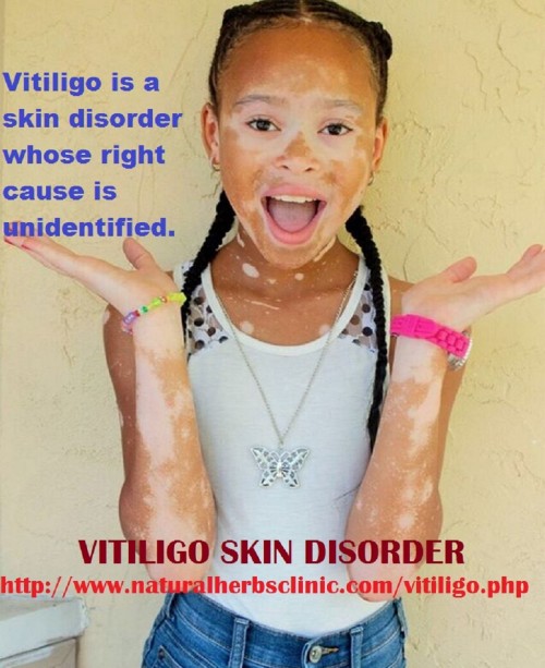 The most obvious Vitiligo Symptoms and sign is loss of skin pigment, in result milky white patches appear on skin. Typically happens initial on sun-exposed areas hands, face, arms, feet and legs.... http://naturalherbsclinic.zohosites.com/read-all-information-about-vitiligo-skin-disorder.html