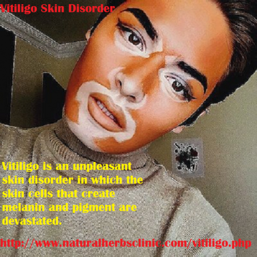 The key Vitiligo Symptoms are when a surprising onset is recognized in most cases where the vitiligo affected person view a single, limited or several milky white patches of rough forms and sizes on the skin.... https://www.behance.net/gallery/48425589/Vitiligo-its-Complications-Symptoms-and-Treatment