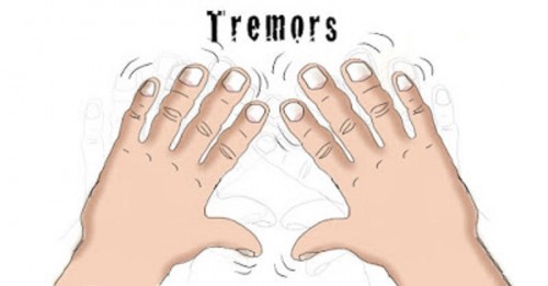 For patients with restricting tremor that is not sufficiently recover medications, surgical Benign Essential Tremor Treatment might be an opportunity. Modern surgical options for ET contain Deep Brain Stimulation (DBS), Thalamotomy and Focused Ultrasound... http://tiny.cc/2setiy