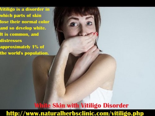 The Symptoms of Vitiligo contain: Skin discoloration. Premature whitening or graying of the hair on your scalp, eyebrows, eyelashes, or beard (generally before 35 of age) Loss of pigment in the tissues that line the in to your mouth and nose.... http://vitiligosymptom.blogspot.com/2016/11/vitiligo-overview-recovery-of-vitiligo.html
